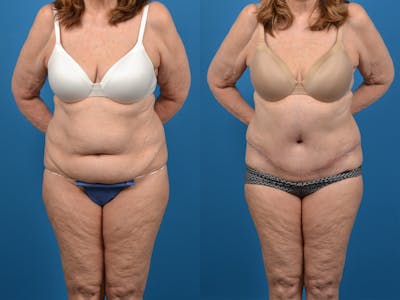 Abdominoplasty Before & After Gallery - Patient 18427840 - Image 1