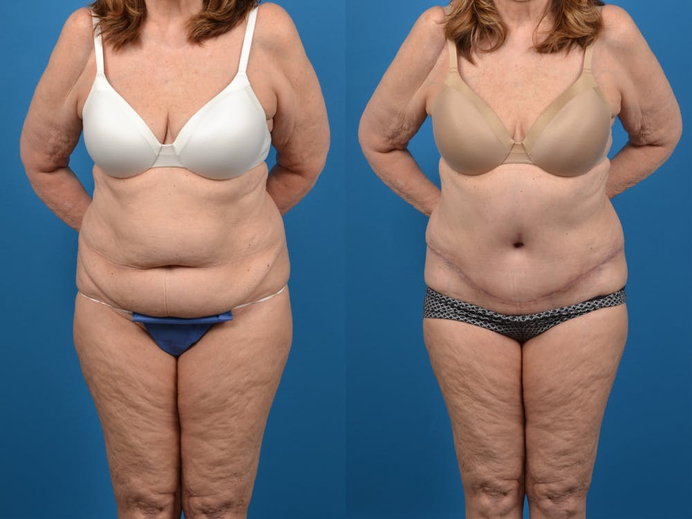 Abdominoplasty Before & After Gallery - Patient 18427840 - Image 1