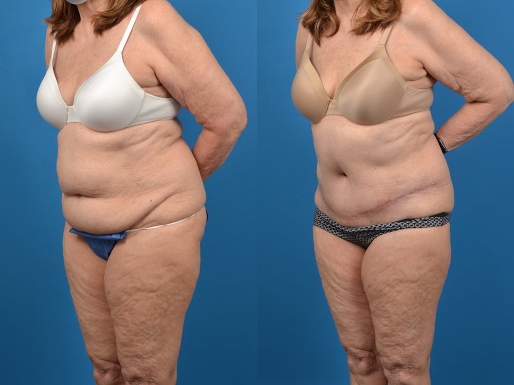 Abdominoplasty Before & After Gallery - Patient 18427840 - Image 2