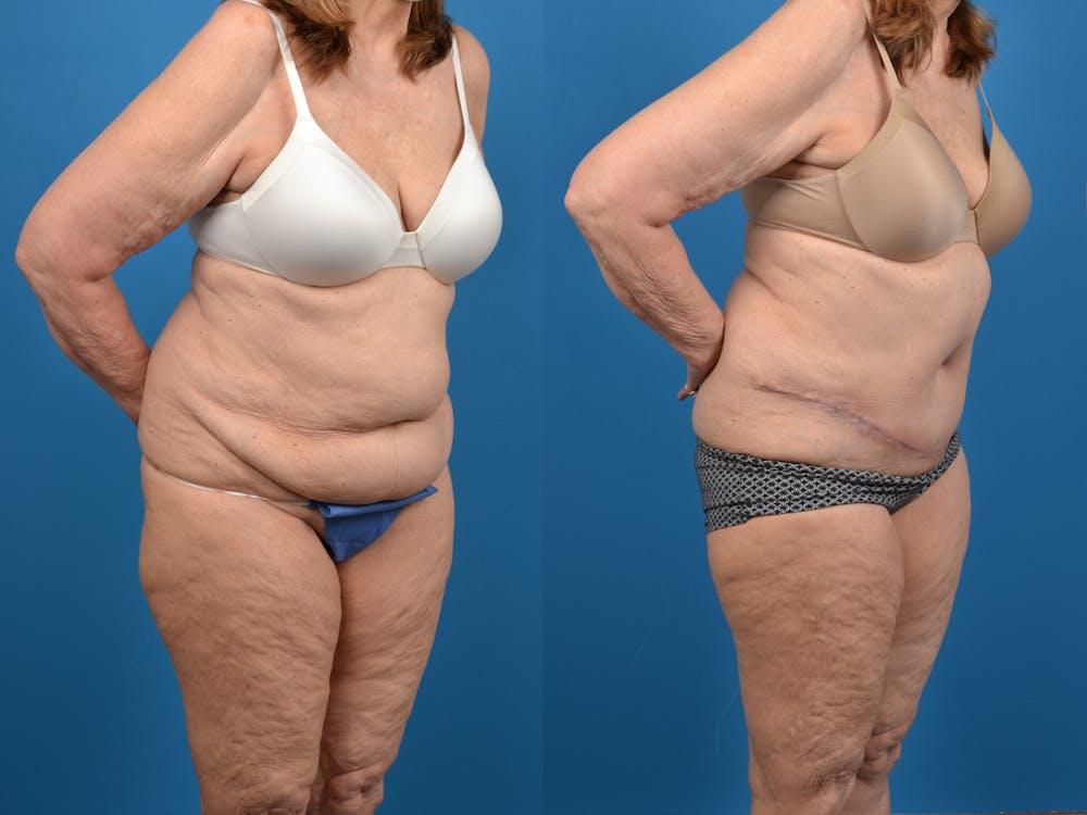 Abdominoplasty Before & After Gallery - Patient 18427840 - Image 3