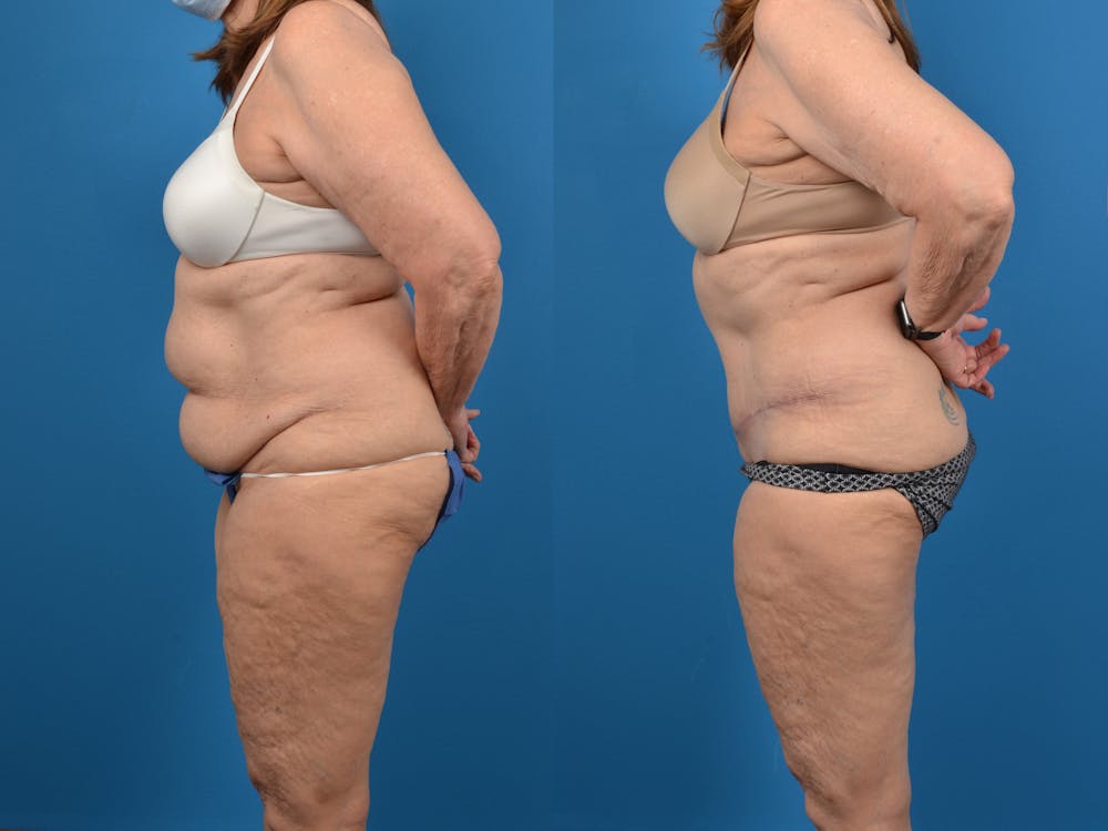 Abdominoplasty Before & After Gallery - Patient 18427840 - Image 4
