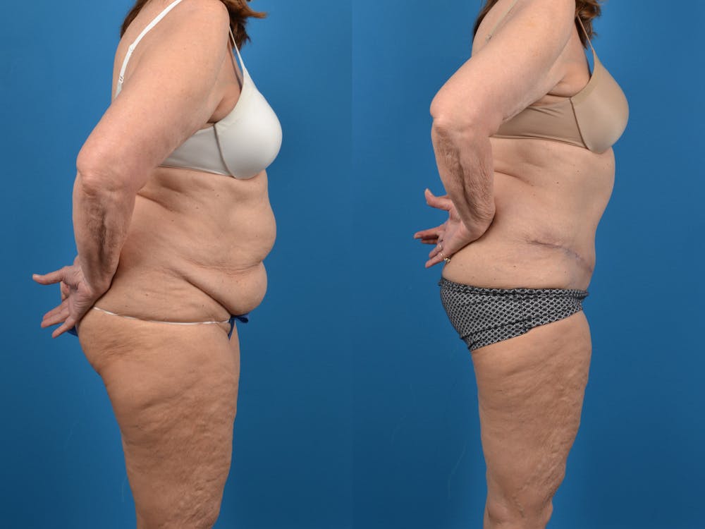 Abdominoplasty Before & After Gallery - Patient 18427840 - Image 5