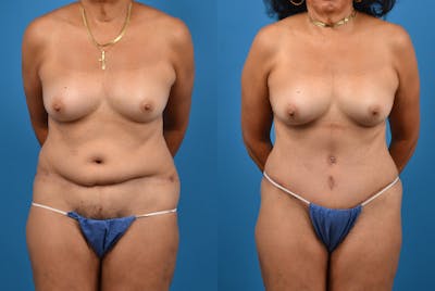 Abdominoplasty Before & After Gallery - Patient 18427841 - Image 1