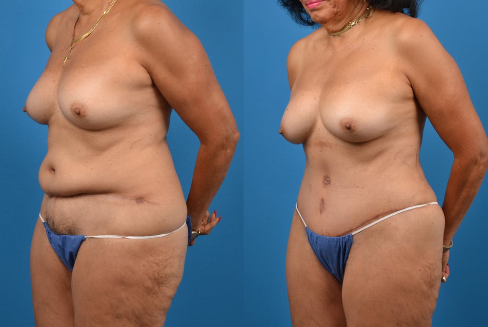 Abdominoplasty Before & After Gallery - Patient 18427841 - Image 2