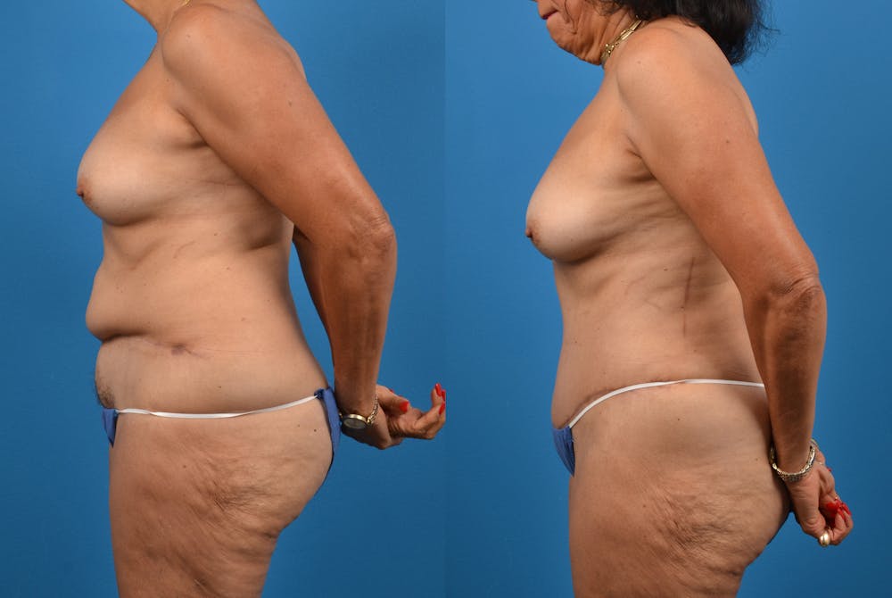 Abdominoplasty Before & After Gallery - Patient 18427841 - Image 3