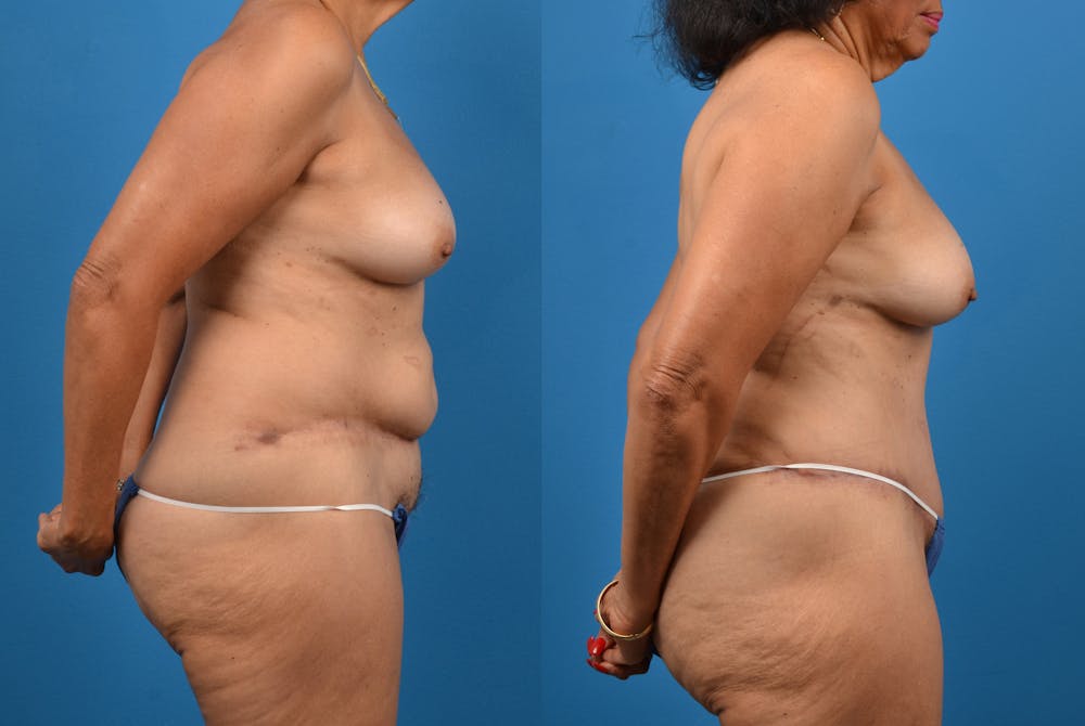 Abdominoplasty Before & After Gallery - Patient 18427841 - Image 4