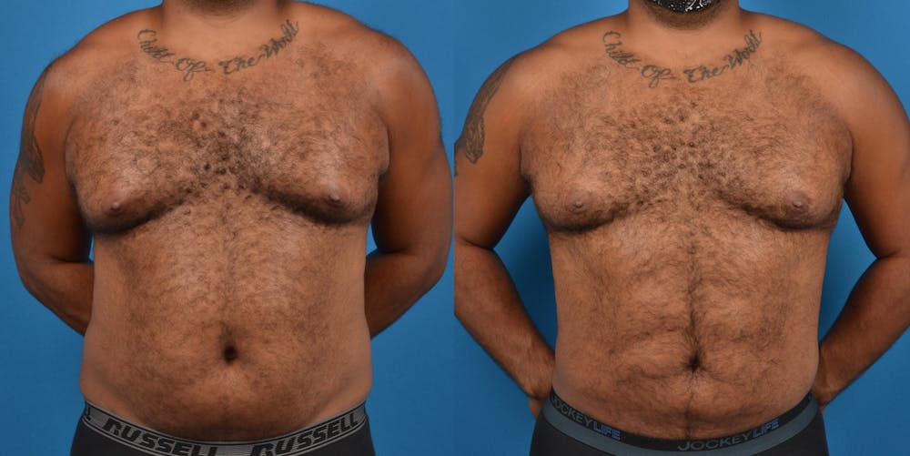 Abdominal Etching Before & After Gallery - Patient 18427898 - Image 1