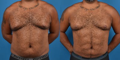 Abdominal Etching Before & After Gallery - Patient 18427898 - Image 1