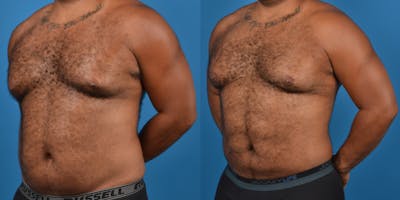 Abdominal Etching Before & After Gallery - Patient 18427898 - Image 2