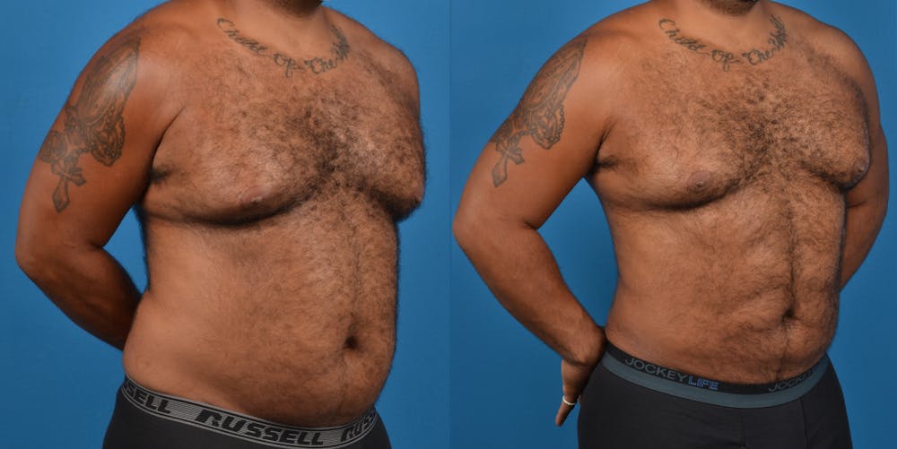 Abdominal Etching Before & After Gallery - Patient 18427898 - Image 3