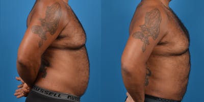 Abdominal Etching Before & After Gallery - Patient 18427898 - Image 4