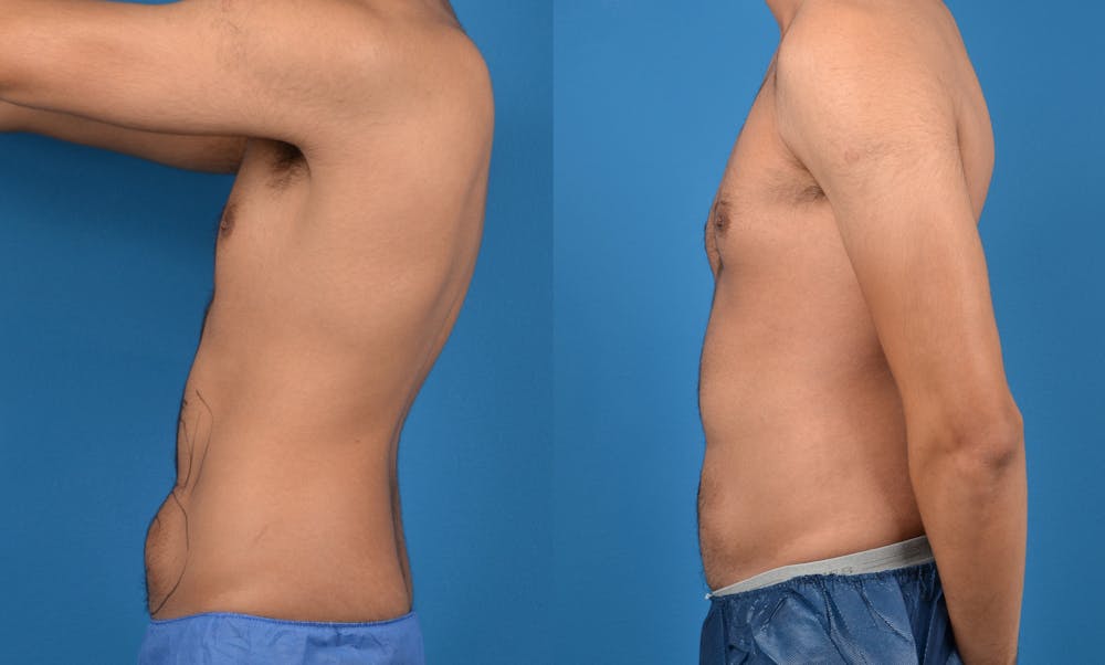 Abdominal Etching Before & After Gallery - Patient 18427899 - Image 2