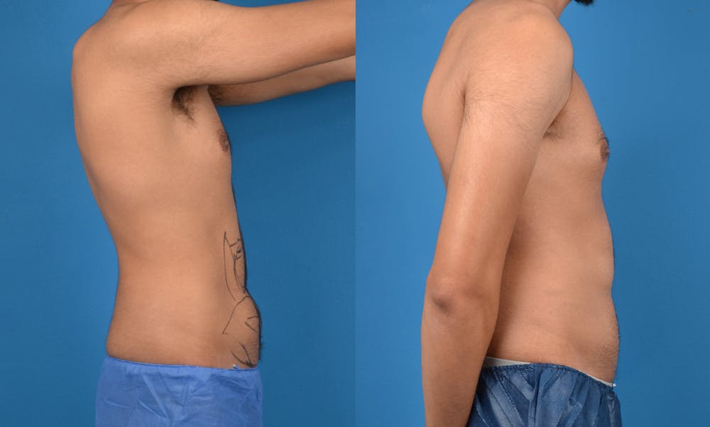 Abdominal Etching Before & After Gallery - Patient 18427899 - Image 3