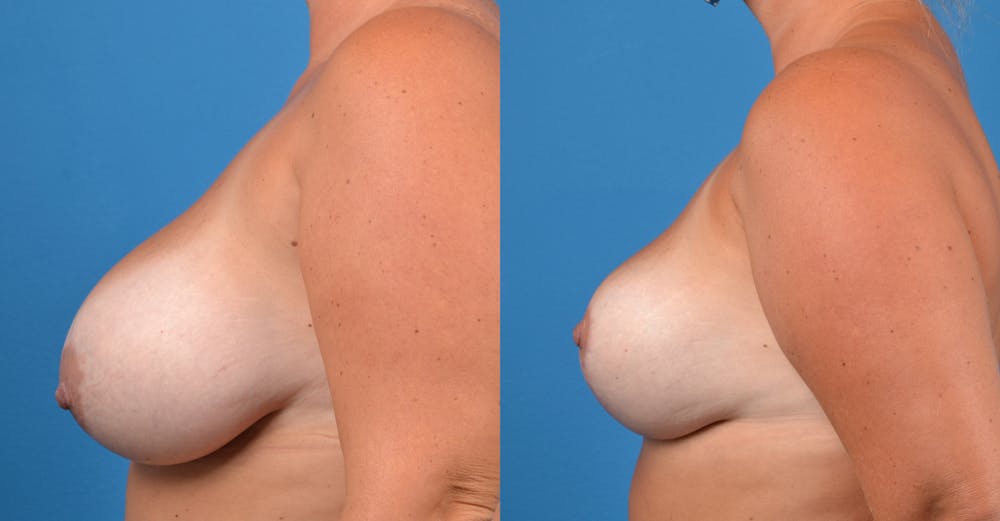 Breast Lift Before & After Gallery - Patient 14242475 - Image 2