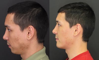 Sliding Genioplasty Before & After Gallery - Patient 18427911 - Image 2