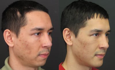 Sliding Genioplasty Before & After Gallery - Patient 18427911 - Image 4