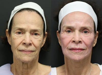 Facelift Before & After Gallery - Patient 14282331 - Image 1