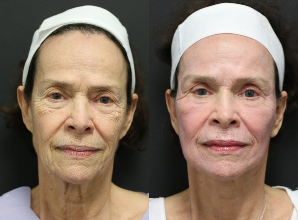 Facelift Before & After Gallery - Patient 14282331 - Image 1