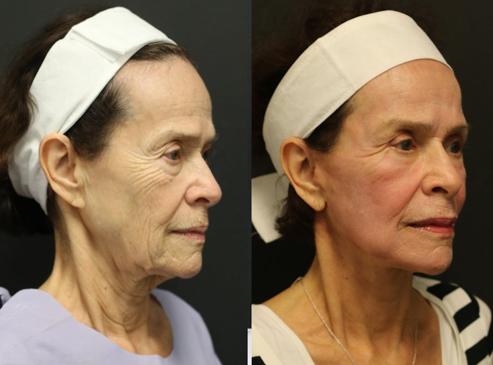 Facelift Before & After Gallery - Patient 14282331 - Image 2