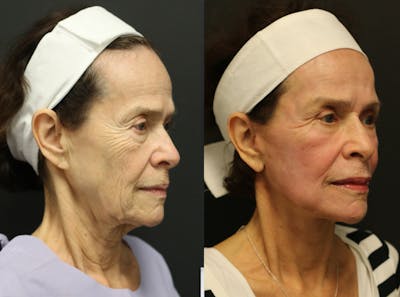 Facelift Before & After Gallery - Patient 14282331 - Image 2