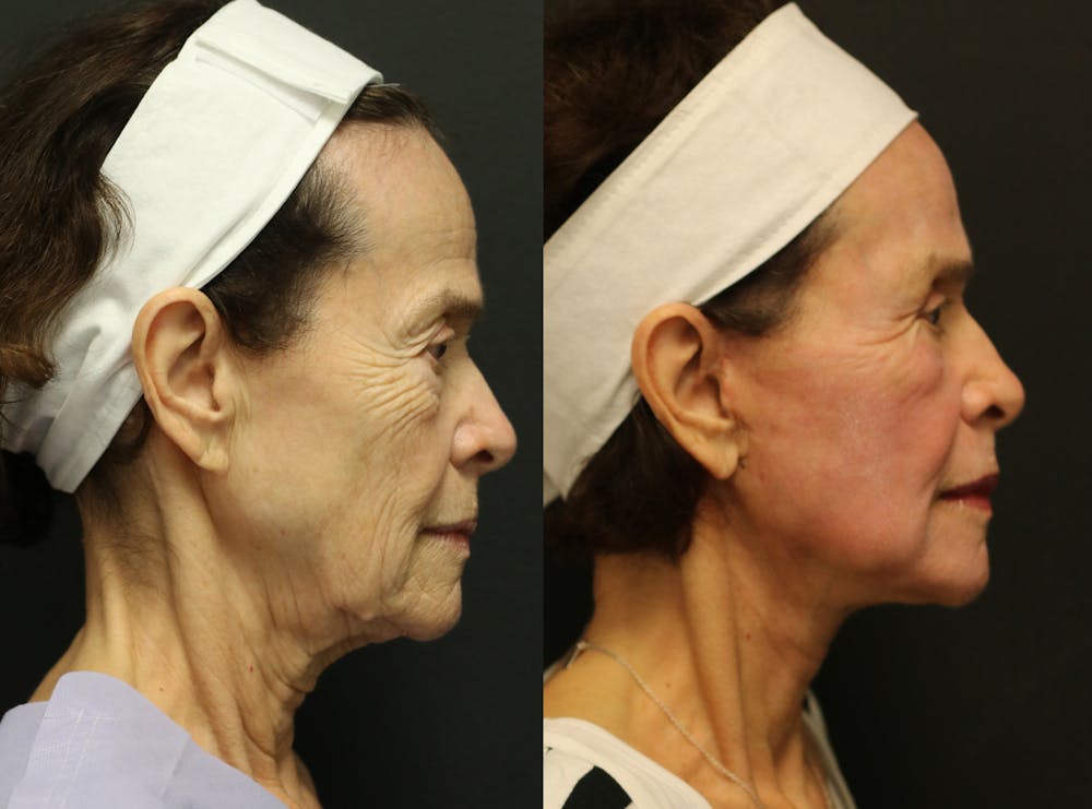 Facelift Before & After Gallery - Patient 14282331 - Image 3