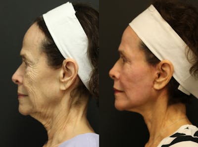 Facelift Before & After Gallery - Patient 14282331 - Image 4