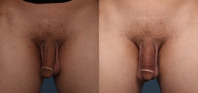 Non-Surgical Phalloplasty Before & After Gallery - Patient 141494463 - Image 1