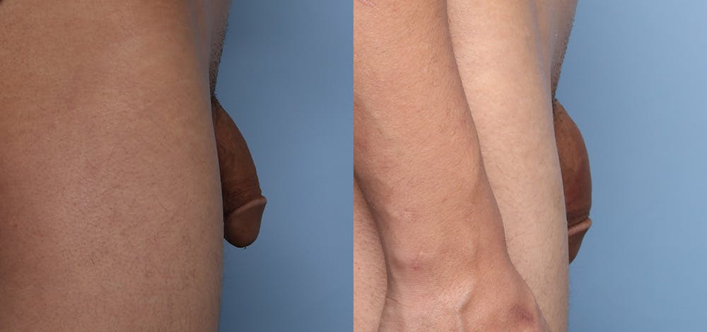 Non-Surgical Phalloplasty Before & After Gallery - Patient 141494463 - Image 3