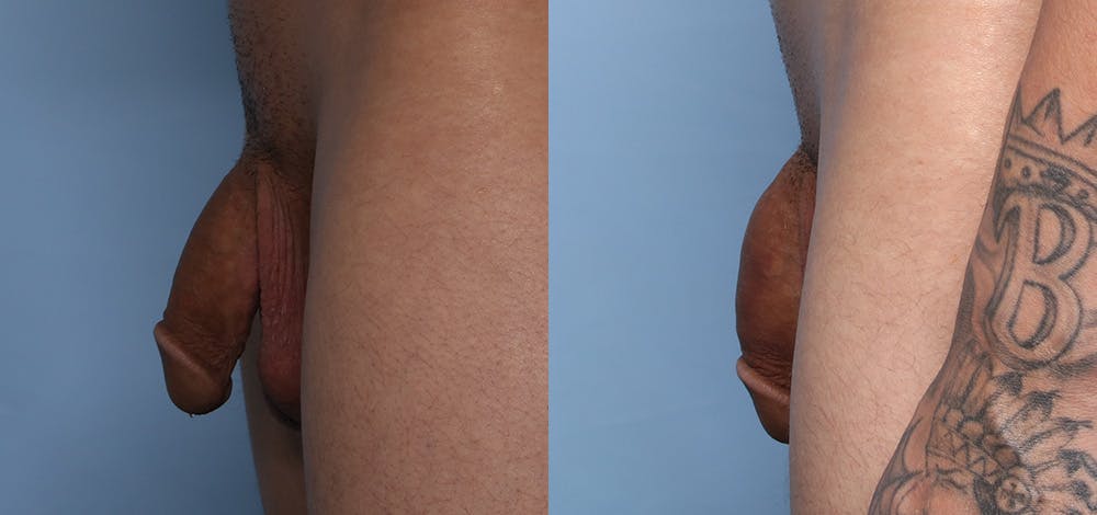 Non-Surgical Phalloplasty Before & After Gallery - Patient 141494463 - Image 5
