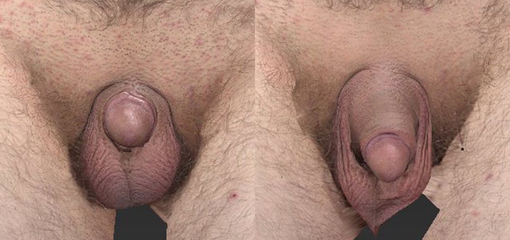 Non-Surgical Phalloplasty Before & After Gallery - Patient 141495330 - Image 1