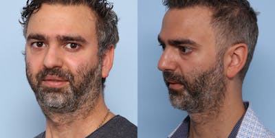 Sliding Genioplasty Before & After Gallery - Patient 121439980 - Image 2