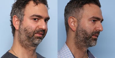 Sliding Genioplasty Before & After Gallery - Patient 121439980 - Image 4