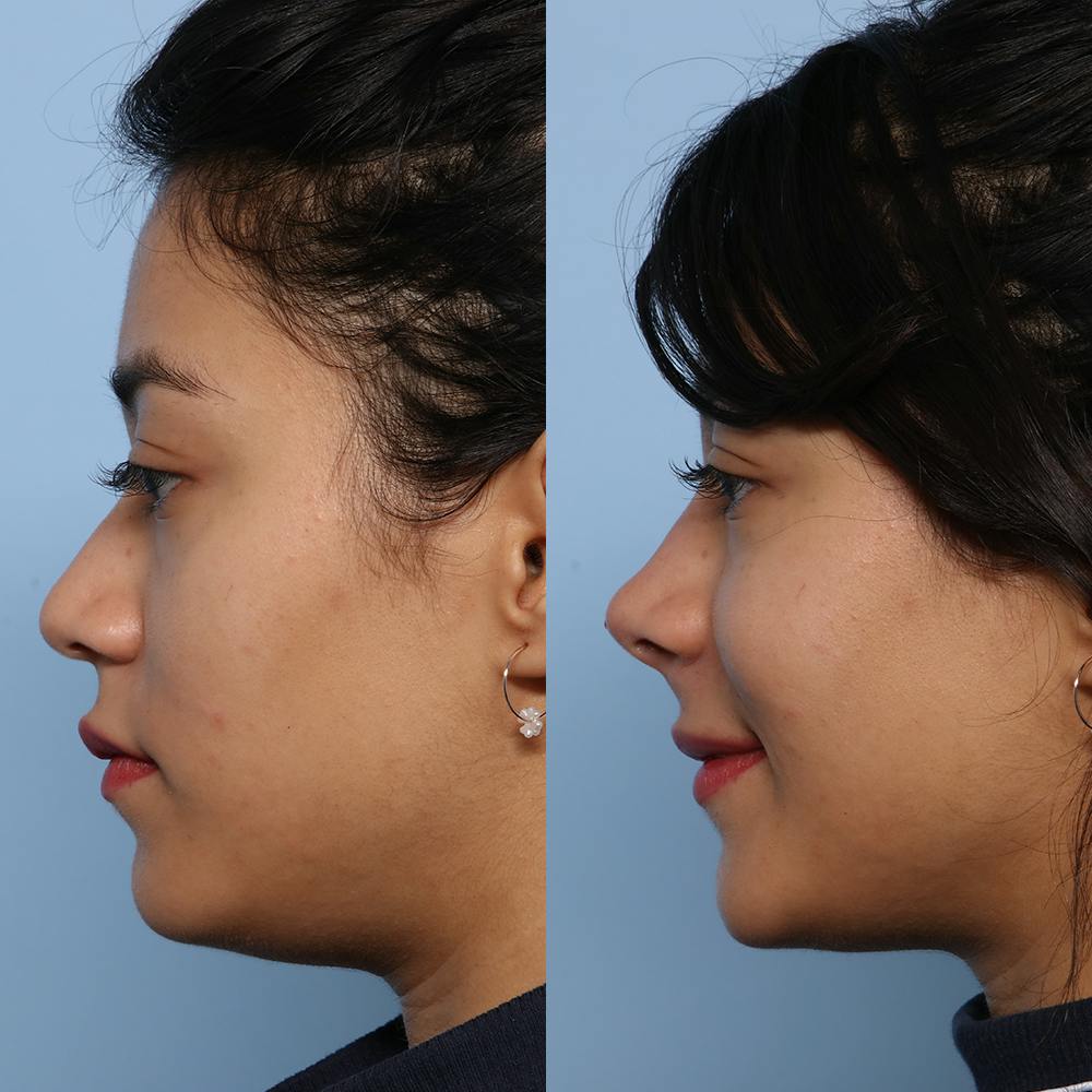 Liquid Rhinoplasty Before & After Gallery - Patient 141495653 - Image 3