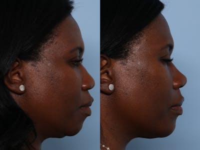 Rhinoplasty Before & After Gallery - Patient 141495656 - Image 1