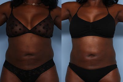 Emsculpt Before & After Gallery - Patient 141495662 - Image 1