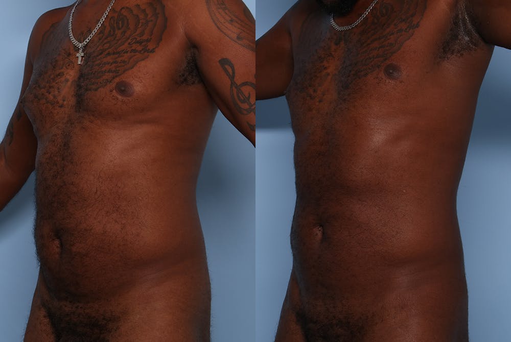 Emsculpt Before & After Gallery - Patient 141495661 - Image 4