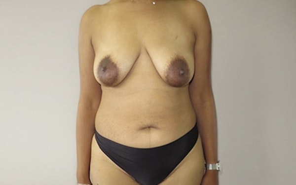 Breast Lift