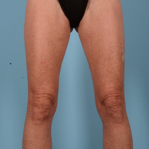 Liposuction Before & After Gallery - Patient 10380581 - Image 1