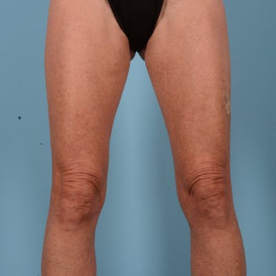 Liposuction Before & After Gallery - Patient 10380581 - Image 1