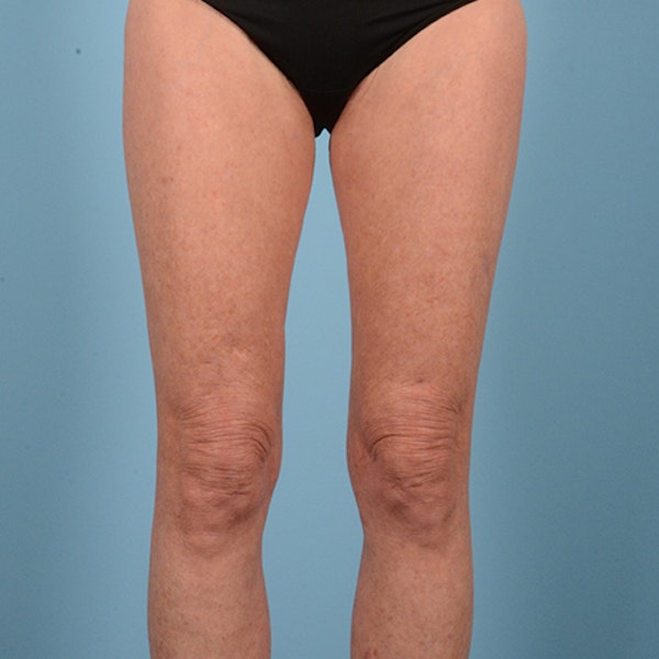 Liposuction