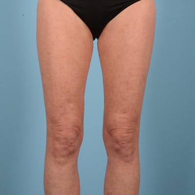 Liposuction Before & After Gallery - Patient 10380581 - Image 2