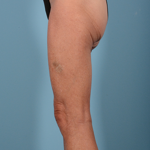 Liposuction Gallery - Patient 10380581 - Image 5