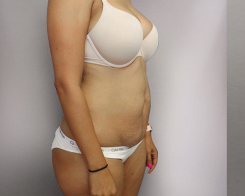 Tummy Tuck Gallery - Patient 10380588 - Image 1