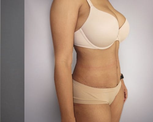 Tummy Tuck (Abdominoplasty)  Before & After Gallery - Patient 10380588 - Image 2
