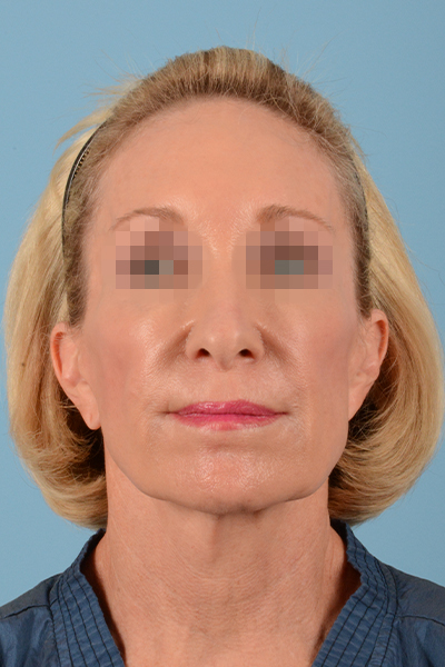 Facelift Before & After Gallery - Patient 10380596 - Image 1