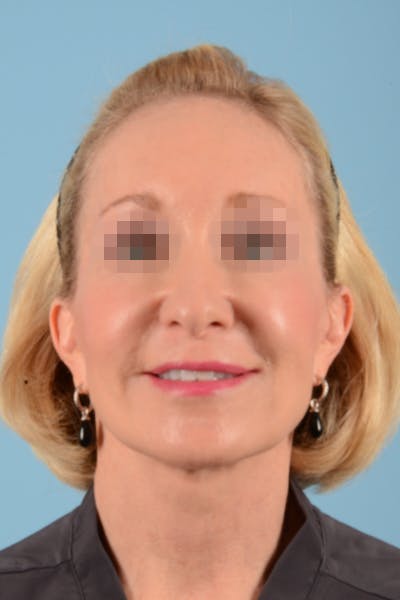Facelift Before & After Gallery - Patient 10380596 - Image 2