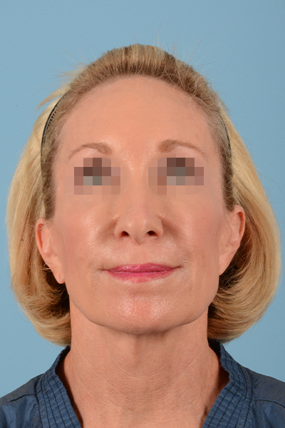 Facelift Before & After Gallery - Patient 10380596 - Image 3