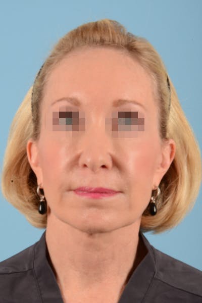 Facelift Before & After Gallery - Patient 10380596 - Image 4