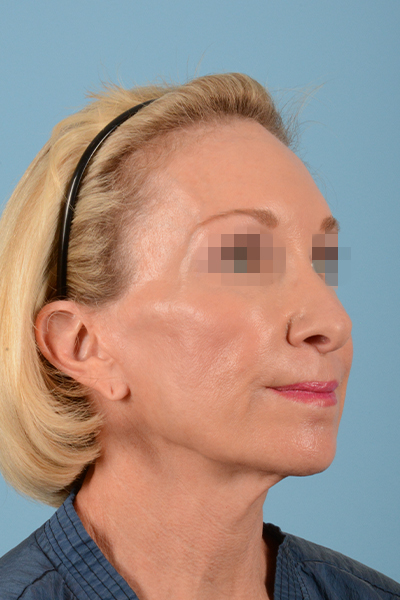 Facelift Before & After Gallery - Patient 10380596 - Image 5