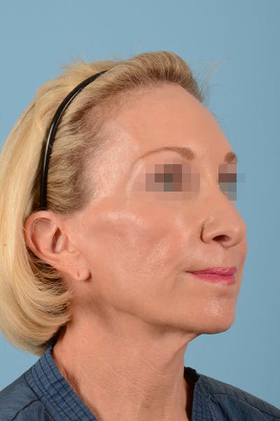Facelift Before & After Gallery - Patient 10380596 - Image 5